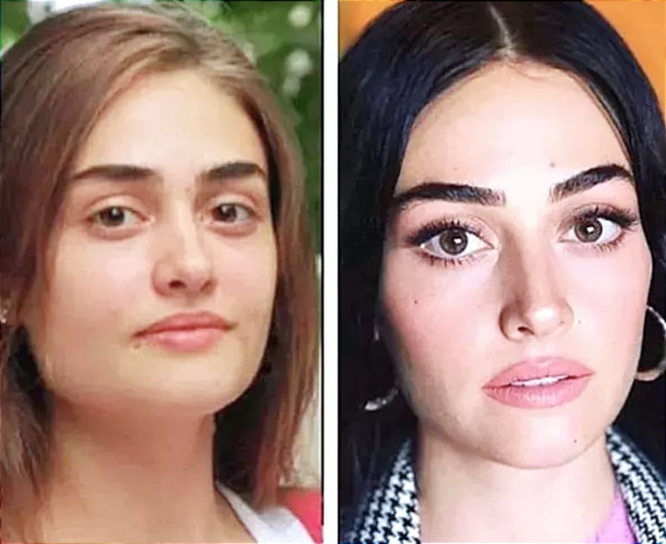 Esra Bilgiç (before and after)