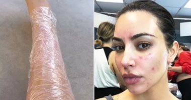 مرض جلدي مناعى تعانى منه كيم كاردشيان يجعلها تغلف جسمها بالبلاستيك