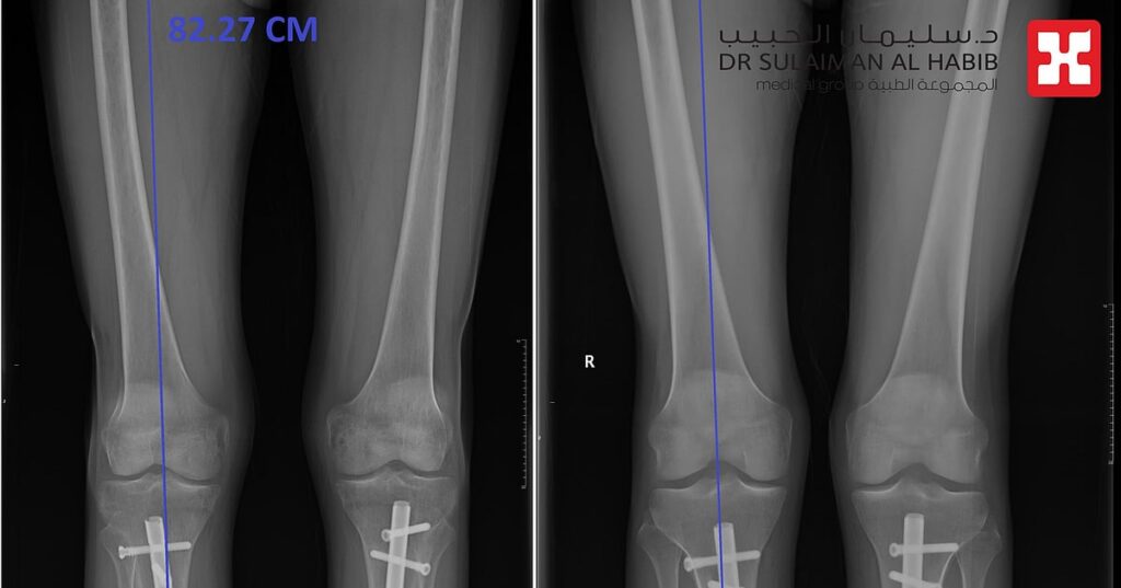مستشفى الدكتور سليمان الحبيب بالخبر.. نجاح لافت لعمليات تطويل العظام عبر تقنية “المسمار النخاعي” مستشفى الدكتور سليمان الحبيب بالخبر.. نجاح لافت لعمليات تطويل العظام عبر تقنية "المسمار النخاعي"