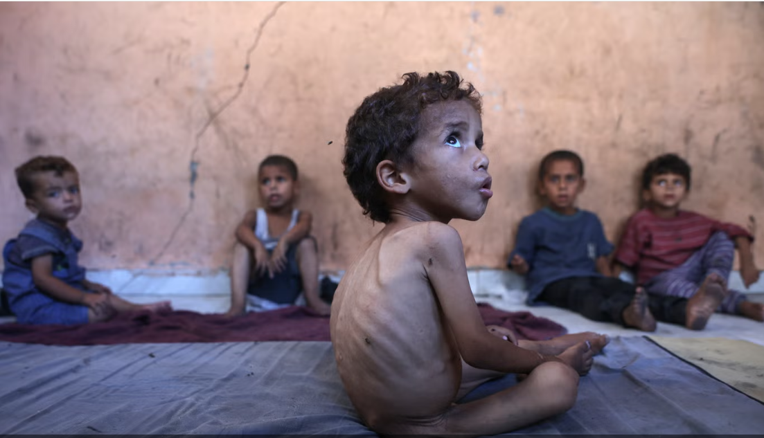 الاطفال فى غزة يعانون سوء التغذية