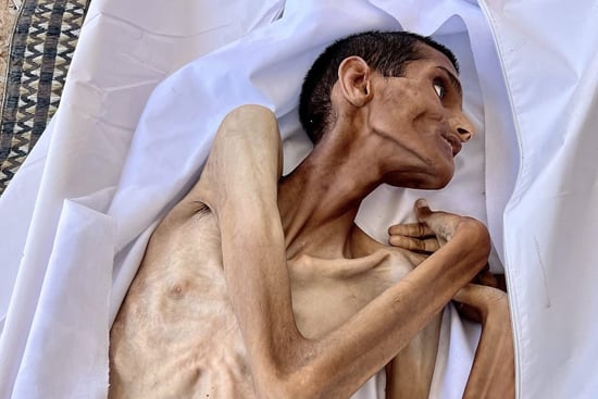 شاب فلسطينى يموت جوعا فى مستشفى الشفاء