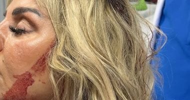 رزان مغربي تطمئن جمهورها بعد إصابة الرأس.. ودنيا سمير غانم تدعو لها