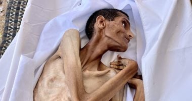 شاب فلسطينى يموت جوعا فى مستشفى الشفاء الطبى بغزة.. صورة