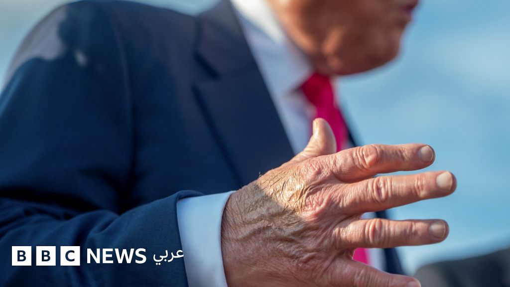 ترامب: ما هي الحالة الصحية لترامب بعد ظهور تورم في ساقيه وكدمات في يديه؟