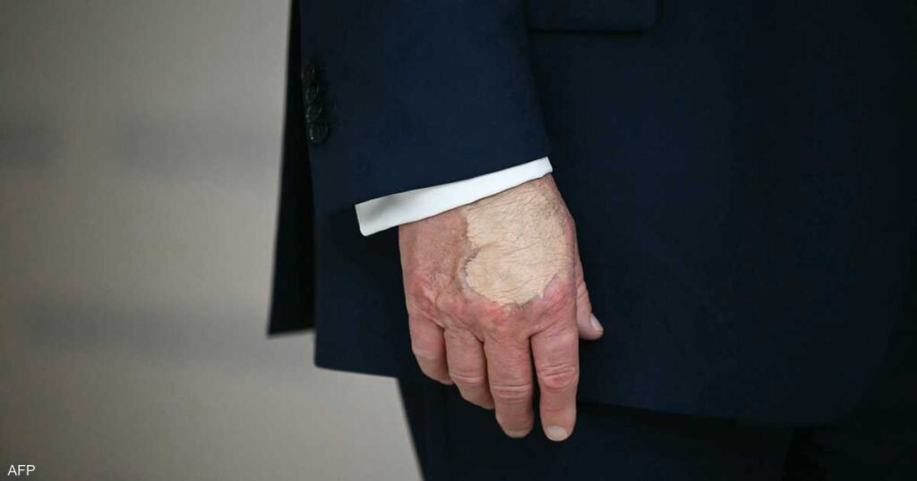 ترامب يخفي “كدمة المصافحة”.. المكياج أثار موجة تساؤلات ترامب يخفي "كدمة المصافحة".. المكياج أثار موجة تساؤلات