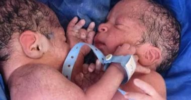 حالة ولادة نادرة لتوأم ملتصق بمستشفى الزقازيق الجامعي