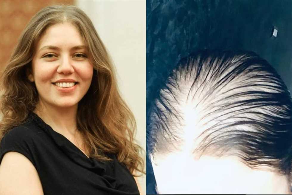 «قلبي مكسور».. رحمة حسن تثير قلق جمهورها بعد تساقط شعرها