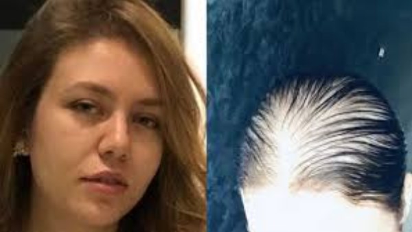 إصابة جديدة تتعرض لها رحمة حسن بعد الصلع