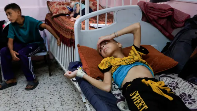 أطفال يعانون من نقص التغذية يبدون منهكين، على أسرة في أحد المستشفيات في غزة
