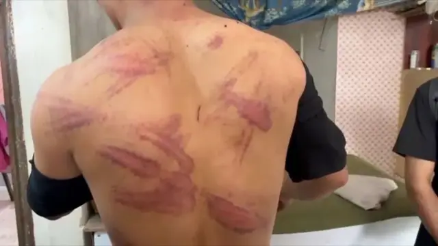 آثار كدمات على ظهر رجل
