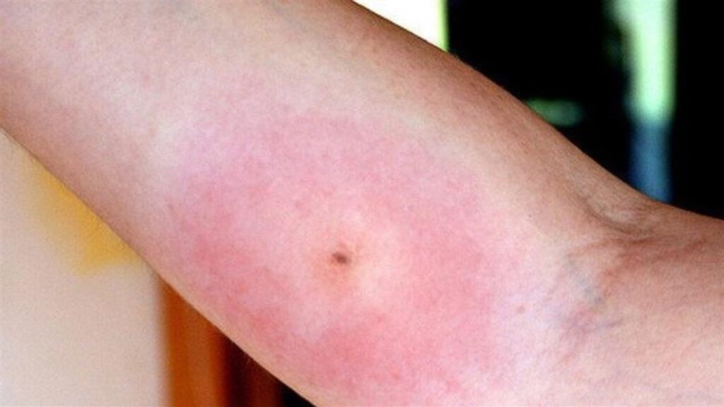 ماذا تعرف عن "مرض القراد" الذي يصيب المشاهير؟