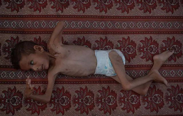 صورة  لطفل مريض بشلل الأطفال يبلغ من العمر خمس سنوات، ينام على سجادة في مخيم للاجئين على طول مدينة غزة، وهو يكافح من أجل البقاء على قيد الحياة، بسبب معاناته من سوء التعذية. يظهر الطفل نحيلاً وجسده هزيل للغاية بينما تبرز العظام من داخل قفصه الصدري.