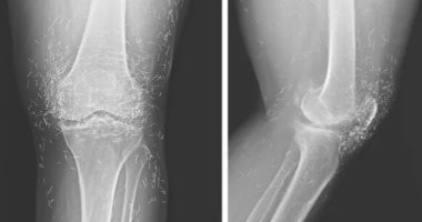 حالة طبية مثيرة للجدل.. سر اكتشاف مئات الخيوط من الذهب فى ركبة امرأة كورية