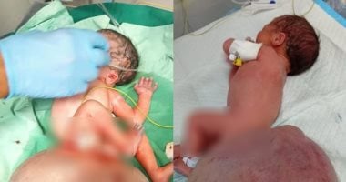 رضيعة فى غزة تصاب بتشوه خلقي لاستنشاق الأم غازات سامة