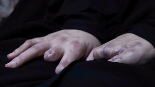 يدا نايفة تستقران على حجرها، إحداهما بها إصبعان مفقودان تقريباً بالكامل، بينما يبدو أن الأخرى لم يتبقَّ منها أي أصابع.