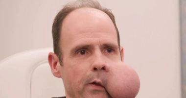 قصة رجل يعيش بورم يزن 2 كجم فى وجهه وينتظر مساعدة الأطباء قصة رجل يعيش بورم يزن 2 كجم فى وجهه وينتظر مساعدة الأطباء