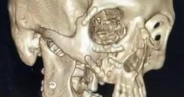 فريق طبى بمستشفى أجا ينجح في إعادة بناء وجه مريض عقب حادث دراجة نارية..صور