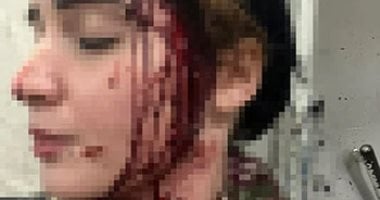 ضحية تشويه وجهها بالعجوزة: المتهم كان يمارس البلطجة ووجهت له تهمة استعراض القوة