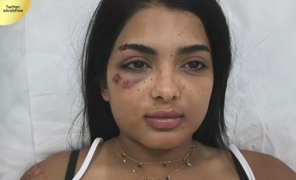 إثر إصابتها في حادثة مرورية.. جود السفياني: «الجروح كثيرة بس أنا بخير» - أخبار السعودية