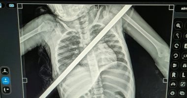3 ساعات فى العمليات.. إنقاذ حياة طفلة اخترق سيخ حديد صدرها فى بنها الجامعى 3 ساعات فى العمليات.. إنقاذ حياة طفلة اخترق سيخ حديد صدرها فى بنها الجامعى