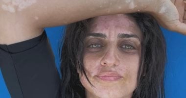 بعد أمير كرارة.. نجوم الفن يساندون شقيقته نسرين عقب إعلان إصابتها بالبهاق
