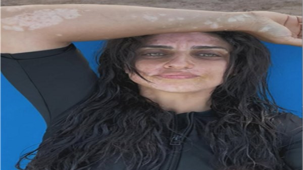 من كلمتين | تعليق أمير كرارة يقلب السوشيال ميديا بعد إصابة شقيقته بـ البهاق